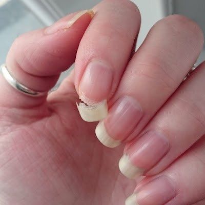 ماذا تخبرنا "الأظافر الشاحبة" عن الكولسترول؟