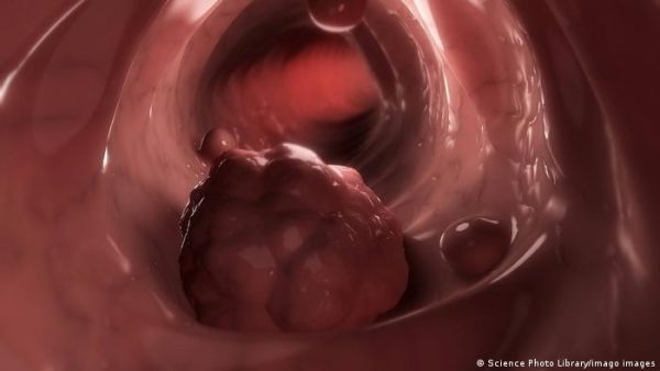 اكتشاف الخلايا المسؤولة عن انتكاس مرضى سرطان القولون