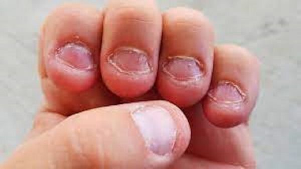 طبيبة تكشف أسباب قضم الأظافر