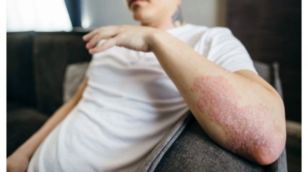 دراسة تربط الأطعمة فائقة المعالجة بمرض الصدفية