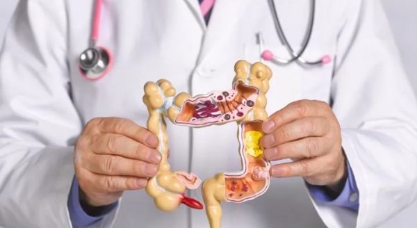 دراسة: سرطان القولون يزداد بين البالغين الشباب