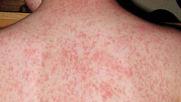 احترس.. الحصبة تسبب مشكلات صحية طويلة الأمد تؤثر على المناعة