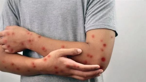 انتشارُ مرض الحصبة بولاية مونتانا الأمريكية للمرة الأولى منذ 35 عامًا