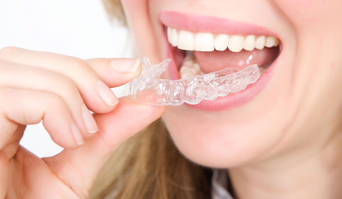 تعرف على أحدث تقنيات تقويم الأسنان.. القالب الشفاف