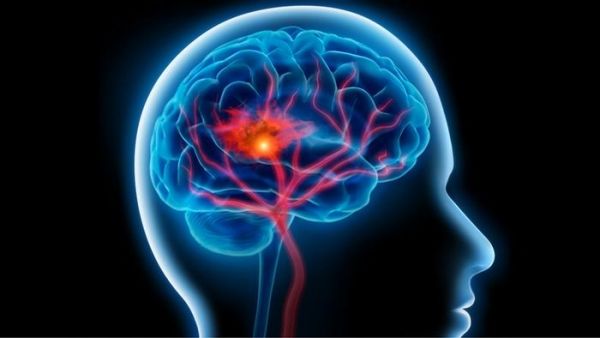 كيف يمكنك تجنب التعرض للسكتة الدماغية؟