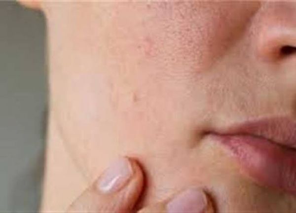 ثلاث علامات على الجلد تشير إلى نقص أحد المغذيات "الأساسية" في الجسم